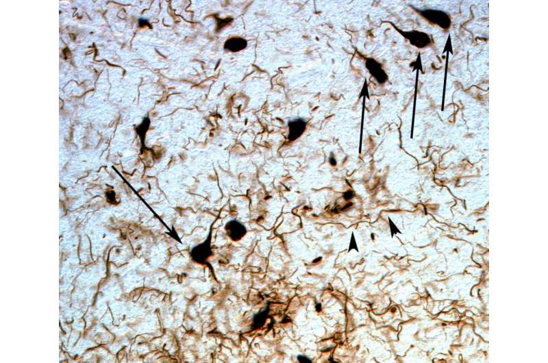 Studying Down syndrome might help us understand Alzheimer's disease better