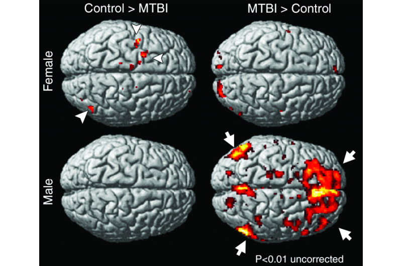 Women show persistent memory impairment after concussion