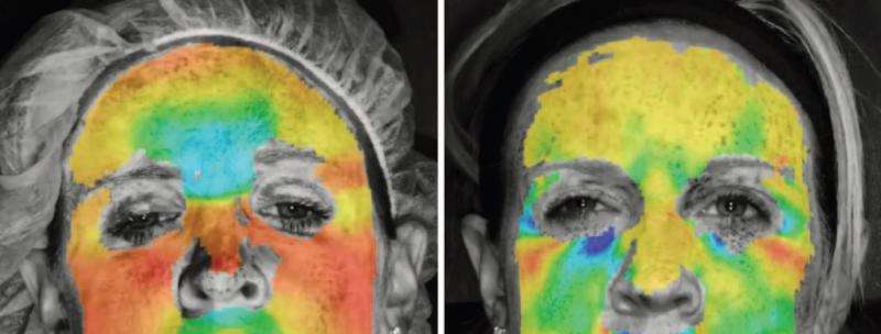 Study reveals novel use of 3-D imaging for measurement of injectable wrinkle reducers
