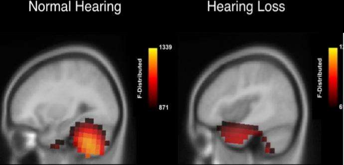 How does the brain respond to hearing loss?