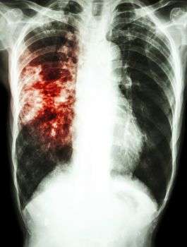 Research reveals new insights into a key antibiotic target in the fight against TB