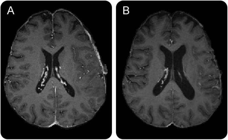 Study reveals effects of chemoradiation in brains of glioblastoma patients