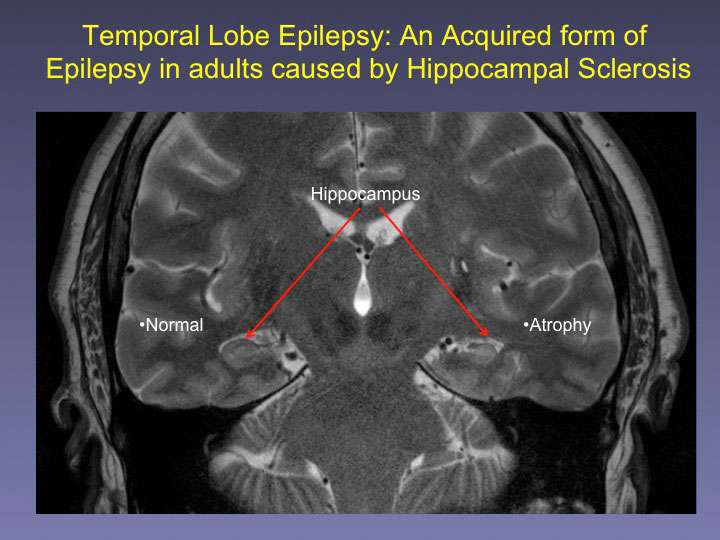 Researchers unlock mystery of memory loss in epilepsy patients