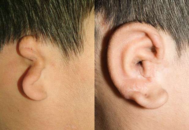 3-D printing techniques help surgeons carve new ears