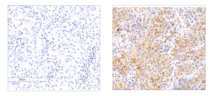 A newly discovered tumor suppressor gene affects melanoma survival