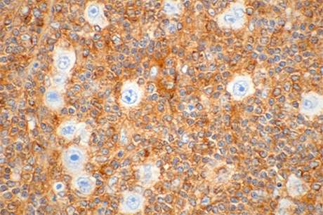 Scientists sequence genome of classical Hodgkin lymphoma