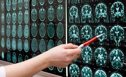 MRI could predict Alzheimer's disease, improving treatment