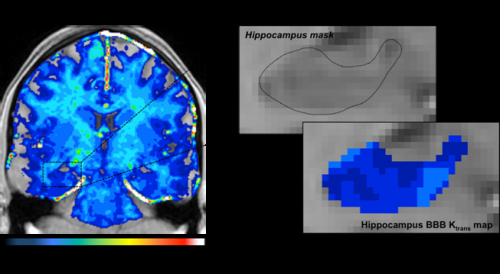 较旧的大脑血管分解，可能导致阿尔茨海默氏症