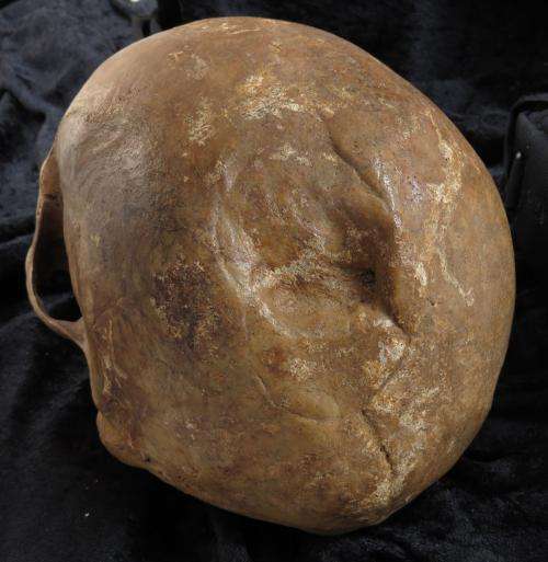 Analysis of skull fractures in medieval Denmark reveals increased risk of death later on in life