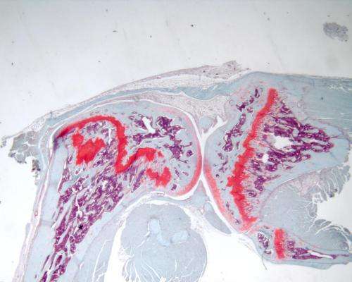 Gene mutation drives cartilage tumor formation