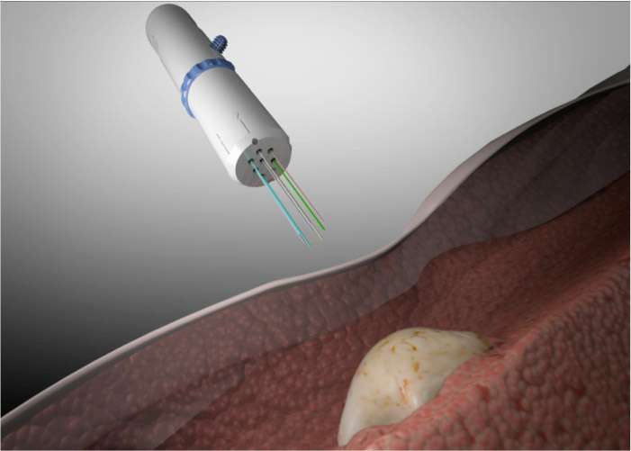 Microinjection platform tests multiple cancer drugs in tumors, predicts systemic response