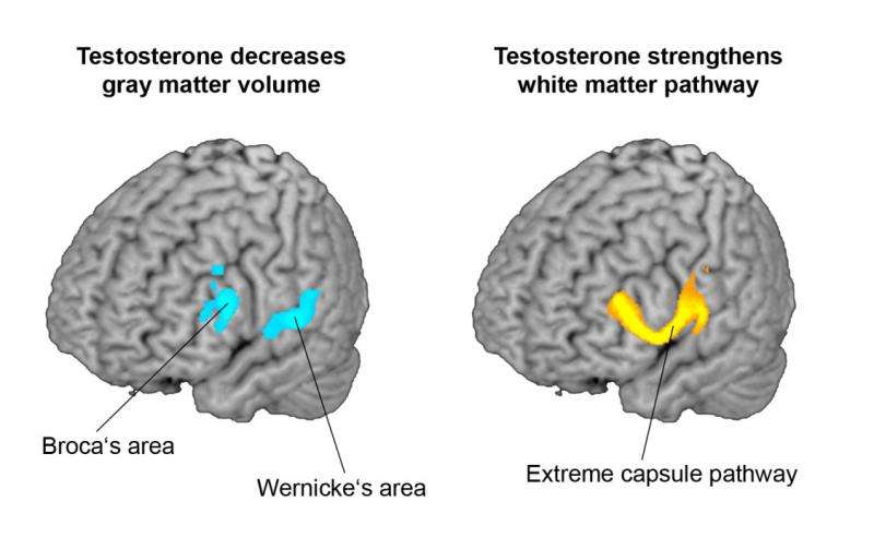 女变男变性手术研究显示睾丸激素改变大脑结构