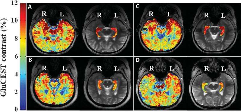 Penn researchers: New neuroimaging method better identifies epileptic lesions