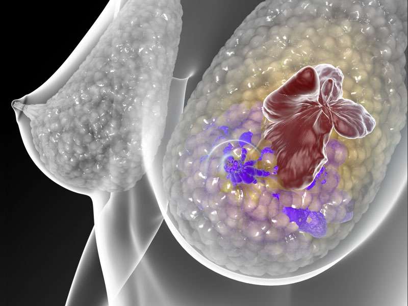 Blood test detects when hormone treatment for breast cancer stops working
