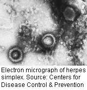Experimental gel could prevent genital herpes infection