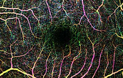 Researchers develop a new method that could save diabetes patients from diabetic retinopathy