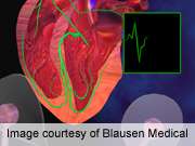 Ablation effectiveness quotient predicts clinical success