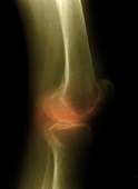 Abnormalities on MRI predict knee replacement