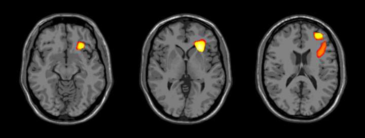 Adolescent brain develops differently in bipolar disorder