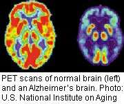 &amp;lt;i&amp;gt;APOE&amp;lt;/i&amp;gt; allele linked to severity of alzheimer's disease