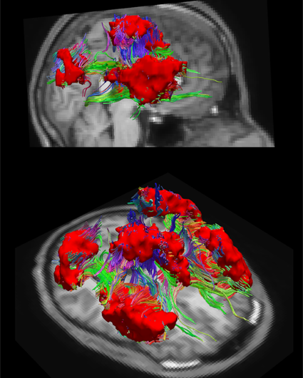A new atlas of the brain opens up alternative means for studying brain disorders