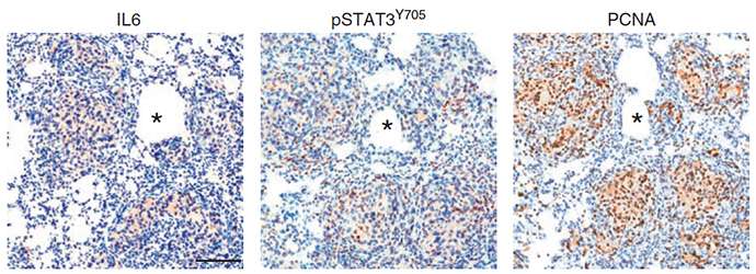 An immune system marker for therapy-resistant prostate cancer