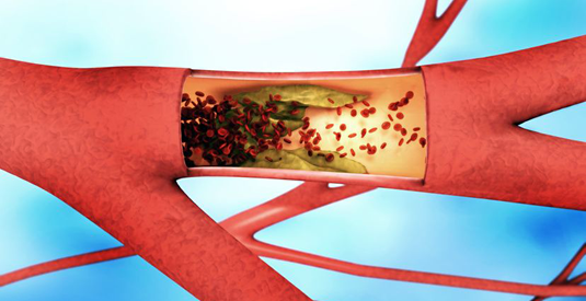 Arterial thrombosis: Cloaking of collagen frees up the flow