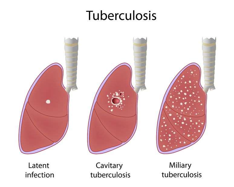 A simple diagnostic test to detect tuberculosis in humans