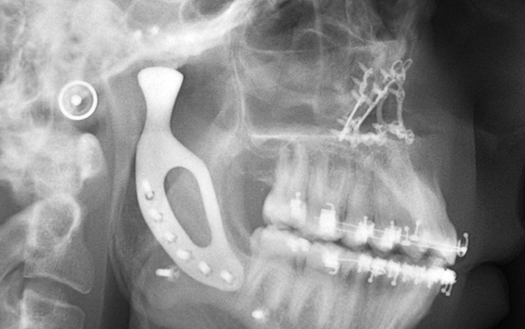 Australian-first for reconstructive surgery uses a 3D printed jaw implant