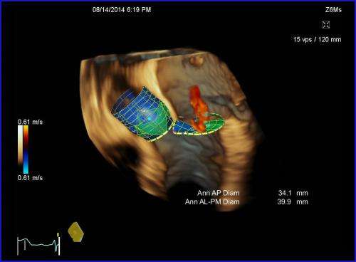 Automatic quantification of heart valves from ultrasound