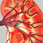 Autosomal dominant polycystic kidney dz pain often refractory