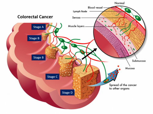 Biomarker Discovery为肠和直肠癌患者提供更清晰的预后