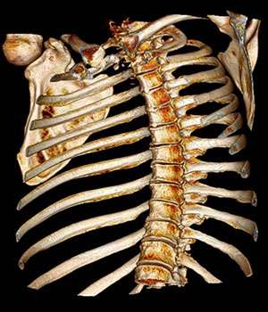 Biomarker monitors testosterone therapy for osteoporosis