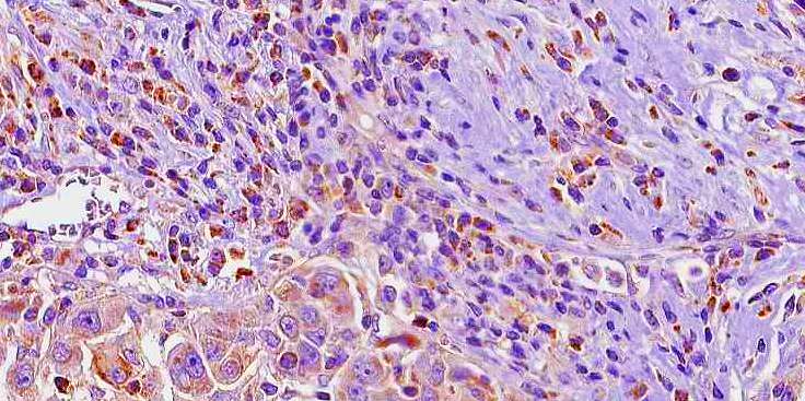 Blocking body's endocannabinoids could be effective liver cancer treatment