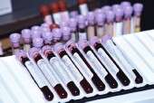 Blood test aims to detect parkinson's in early stages