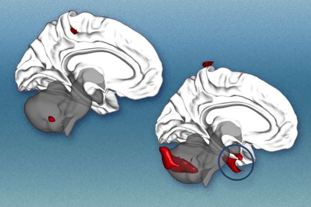 Brain scans can predict the success of treatment for social anxiety disorder