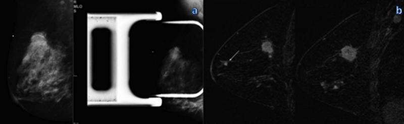 乳房x线照相术后的乳房核磁共振可以识别出其他侵袭性癌症