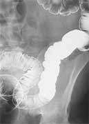Capsule colonoscopy deemed 'Adequate' alternative