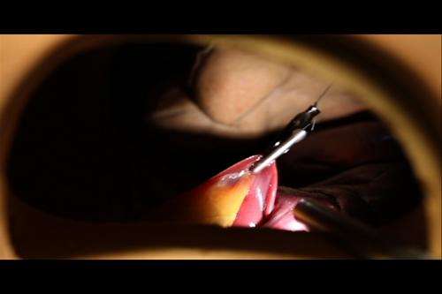 Clever application of magnetic force enhances laparoscopic surgery