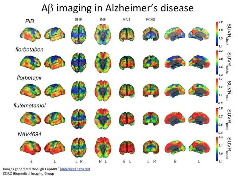 Cloud-based neuroimaging analysis could aid Alzheimer's diagnosis