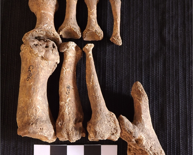 Clues revealed about an ancient case of leprosy