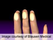 Cold effects on skin in raynaud's impacted by age, BMI