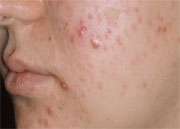 Combo tx using glycolic acid, iontophoresis effective in acne