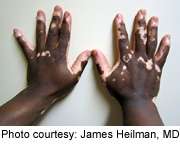 Confetti-like depigmentation may predict vitiligo progression