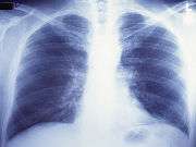 COPD tied to increased risk of ischemic, hemorrhagic stroke