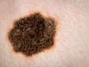Cryotherapy &amp;amp;#43; imiquimod active in cutaneous melanoma mets
