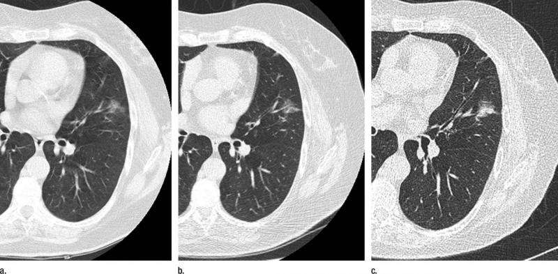 CT allows nonsurgical management of some lung nodules