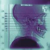 CT scans performed during maxillofacial surgery are rapid
