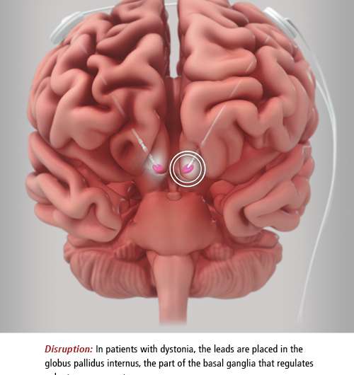 Easing dystonia symptoms with deep brain stimulation