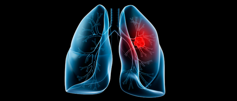 EORTC-ETOP study opens on pembrolizumab for patients with early stage NSCLC cancer